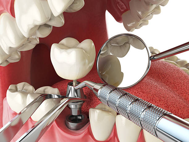 Best Emergency Wisdom Tooth Extraction in College Park, GA